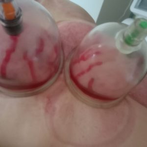 Blood cupping Blood cupping