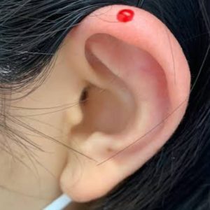 Ear tip bloodletting therapy Ear tip bloodletting therapy