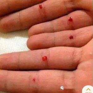 Finger fs bloodletting therapy Finger fs bloodletting therapy